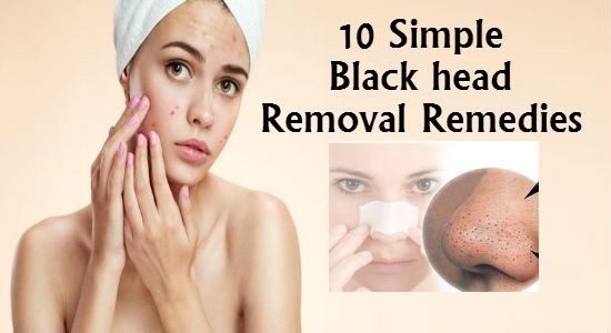 How to get rid of Blackheads